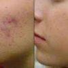 herbal scar removal cream